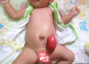 Bayi Terlahir tanpa Anus Butuh Donasi ANDA