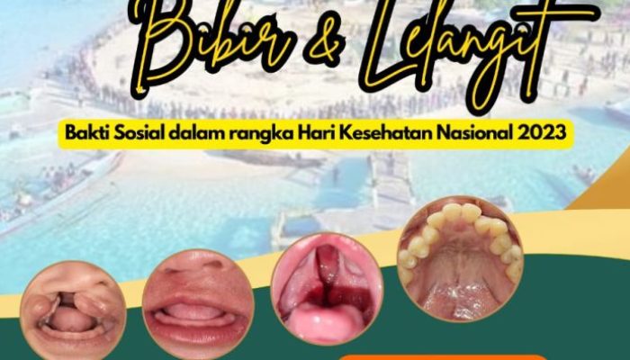 Peringati Hari Kesehatan Nasional RSUD Buol Gelar Bakti Sosial Operasi Bibir Sumbing dan Langit-Langit