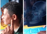 Korban penembakan akan lakukan oprasi ke dua, kasus penembakan di sengaja”