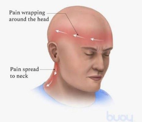 Kenali Tension Type Headache lebih dalam